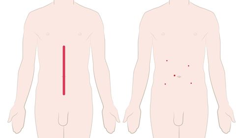 laparoskopiki-kolektomi
