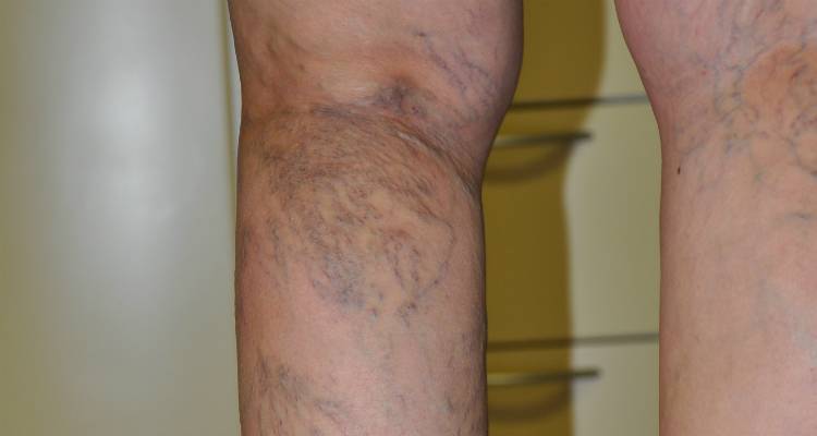 Ευρυαγγείες: Απαραίτητη η εξειδικευμένη θεραπεία τους