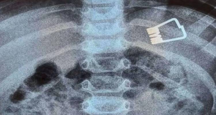 Λήμνος – Αγοράκι δύο ετών κατάπιε έλασμα από μανταλάκι