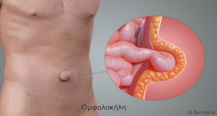 &Eta; &omicron;&mu;&phi;&alpha;&lambda;&omicron;&kappa;ή&lambda;&eta; &kappa;&alpha;&iota; &eta; &lambda;&alpha;&pi;&alpha;&rho;&omicron;&sigma;&kappa;&omicron;&pi;&iota;&kappa;ή &tau;&eta;&sigmaf; &alpha;&nu;&tau;&iota;&mu;&epsilon;&tau;ώ&pi;&iota;&sigma;&eta;