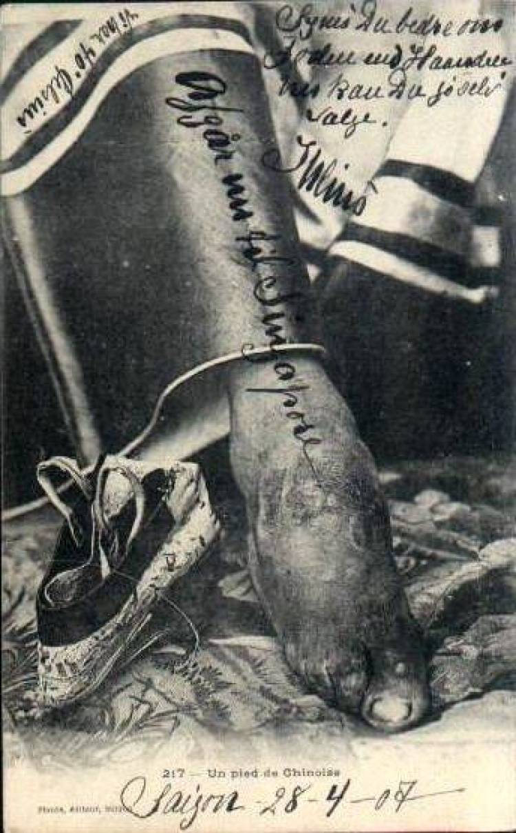 Στενά πόδια: Μια συνήθεια που βασάνισε και σκότωσε χιλιάδες Κινέζες